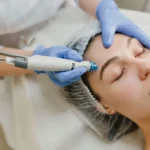میکرونیدلینگ را هر چند وقت یکبار باید انجام داد