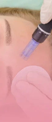 Microneedling (4)